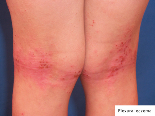 Flexural Eczema