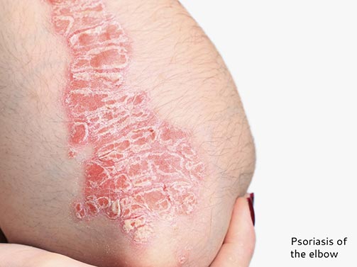 Psoriasis of the elbow