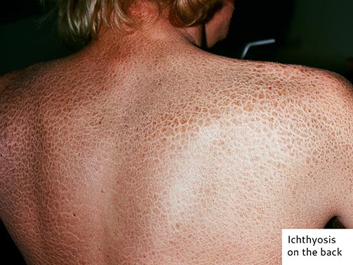 Ichthyosis on the back